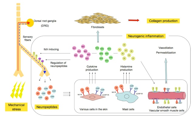 ケロイドにおける神経原性炎症仮説の模式図