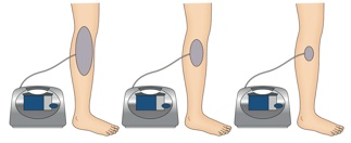 Negative Pressure Wound Therapy and Extracorporeal Shock Wave Therapy