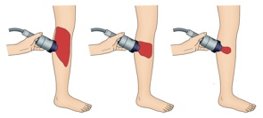 Negative Pressure Wound Therapy and Extracorporeal Shock Wave Therapy