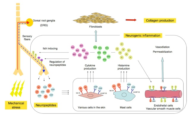 The neurogenic inflammation hypotheses