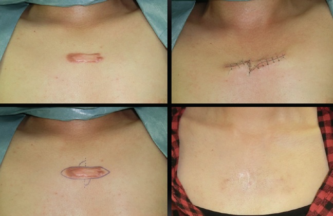 Using mechanotherapy to treat keloid and hypertrophic scars