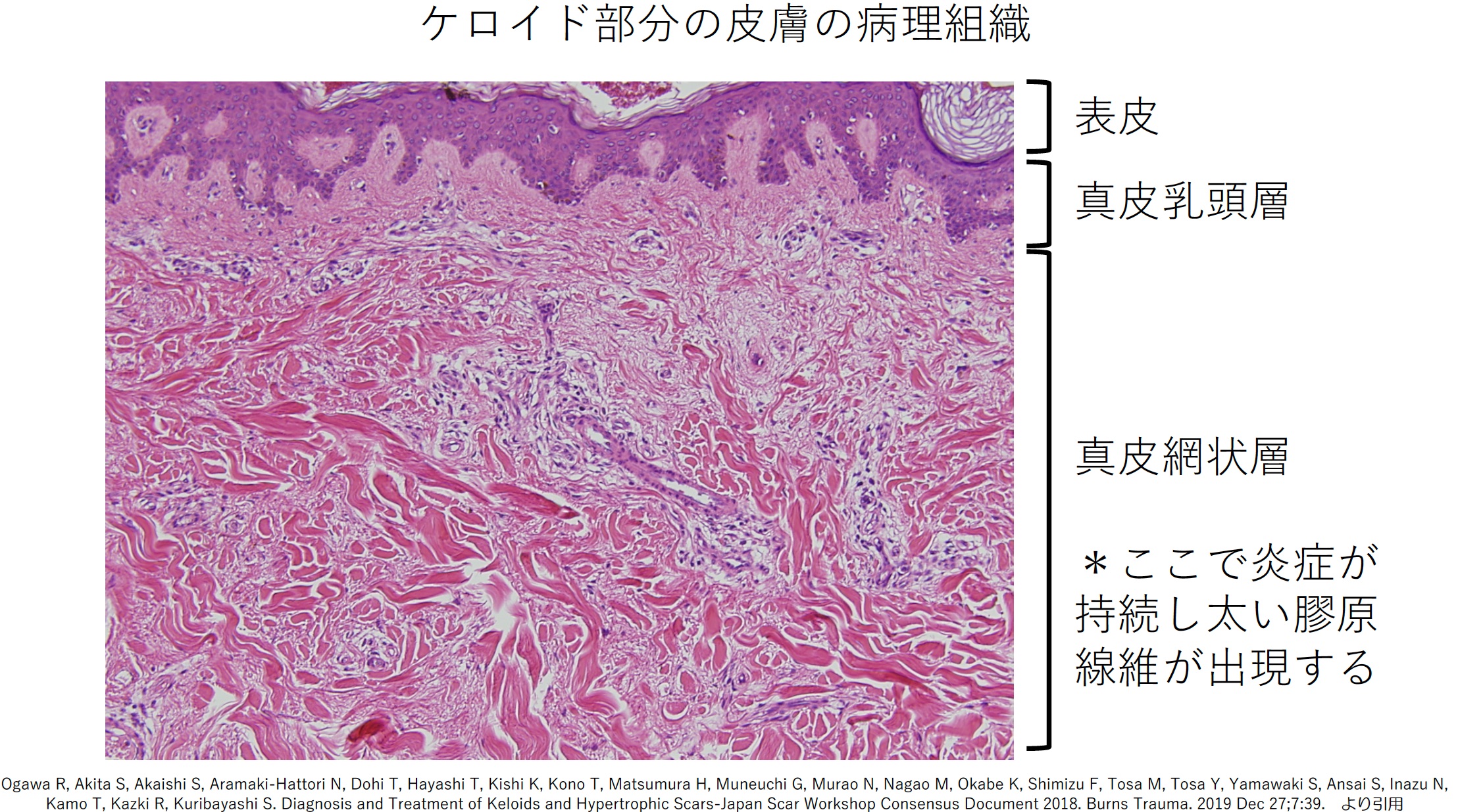 1. ケロイド・肥厚性瘢痕は真皮網状層の慢性炎症である