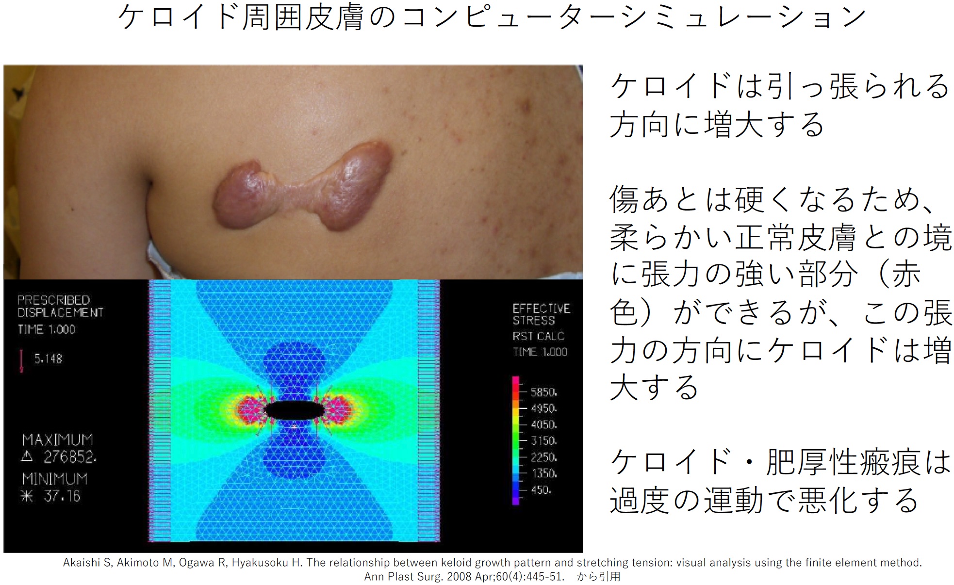 2. ケロイド・肥厚性瘢痕・瘢痕拘縮はよく動かす部位にできやすい