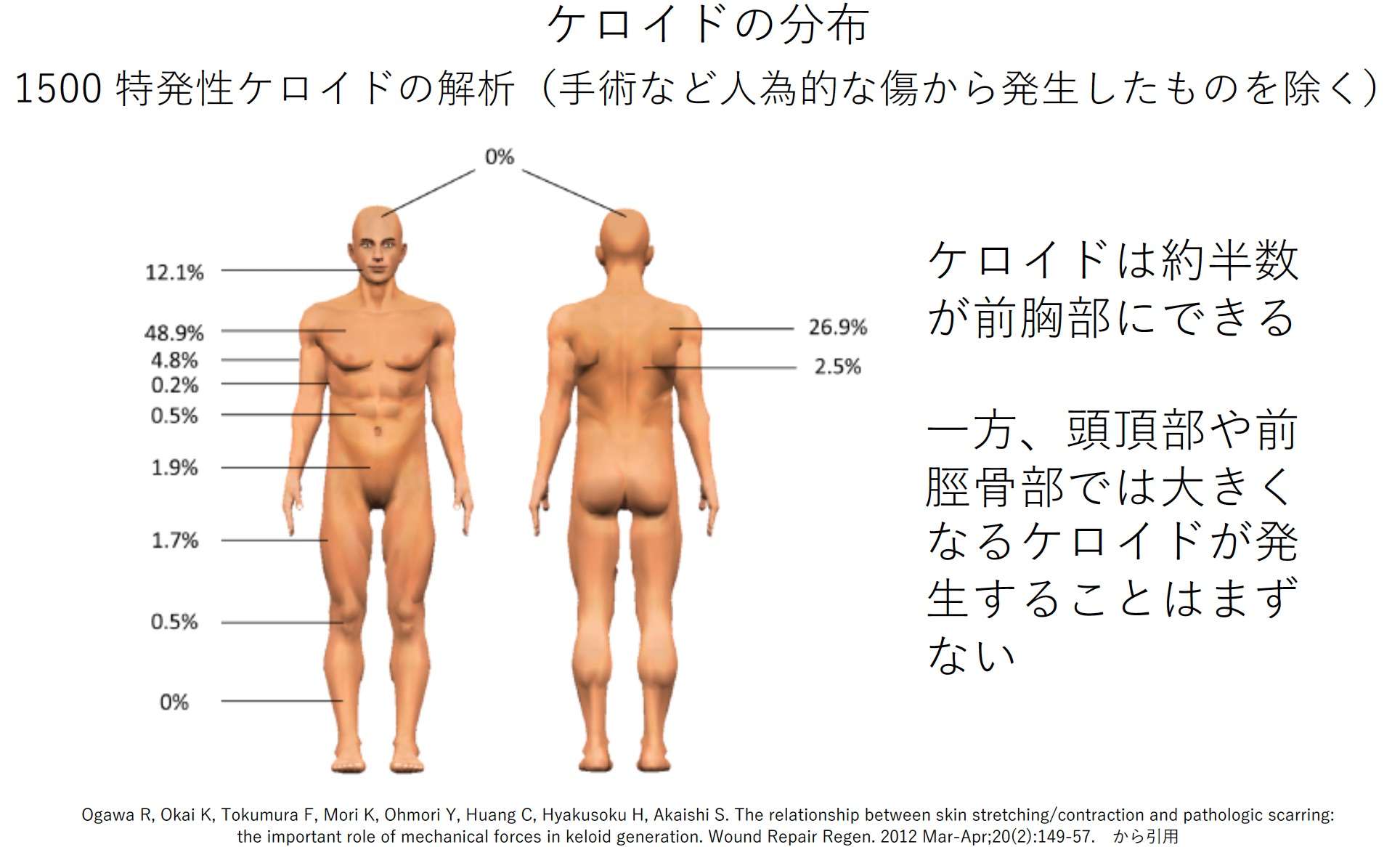 4. ケロイドは頭のてっぺん（頭頂部）・向こう脛（前脛骨部）・まぶた（上眼瞼）からはまず発症しない