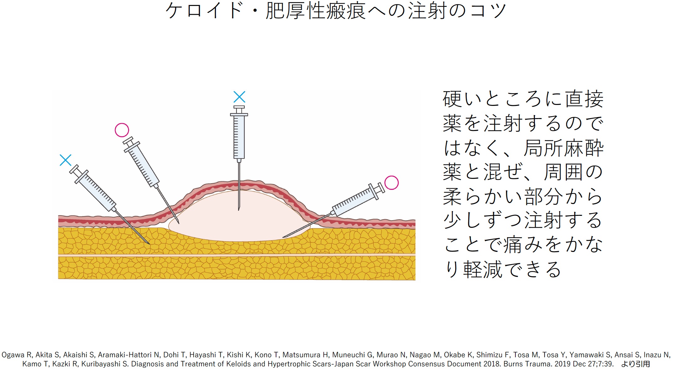 2. ステロイドの注射には痛みが少ない注射方法がある