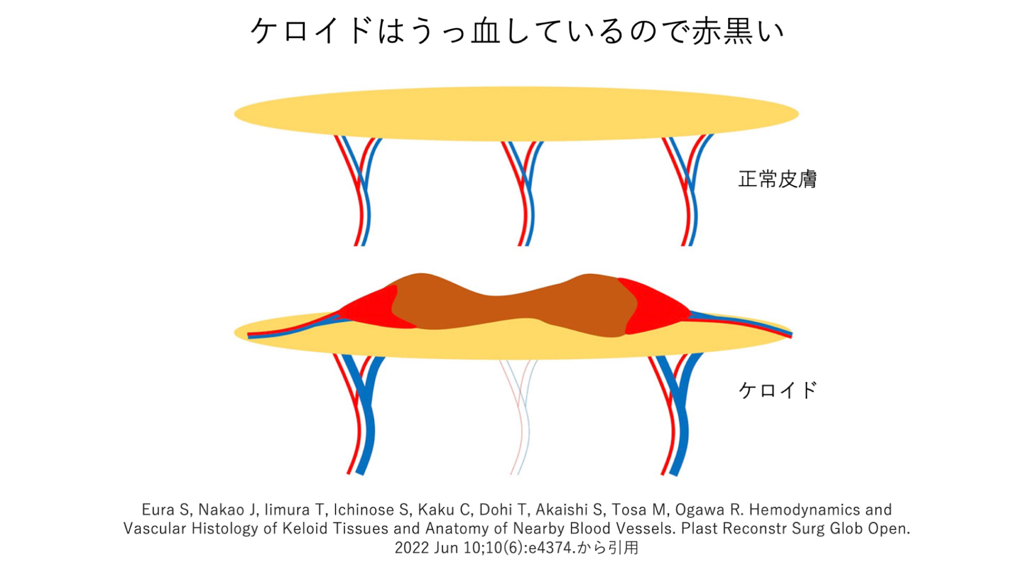 15. ケロイドはうっ血を呈している