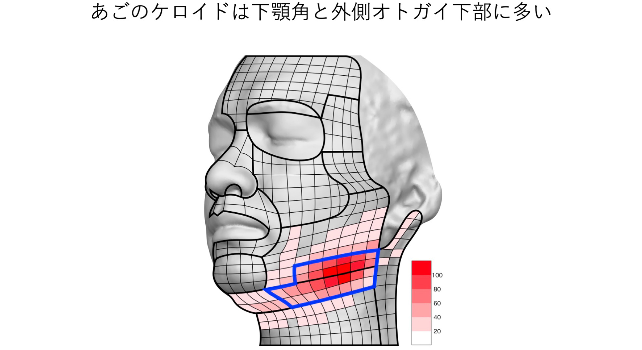20. あごのケロイド（下顎ケロイド）も張力と密接に関連して発生する