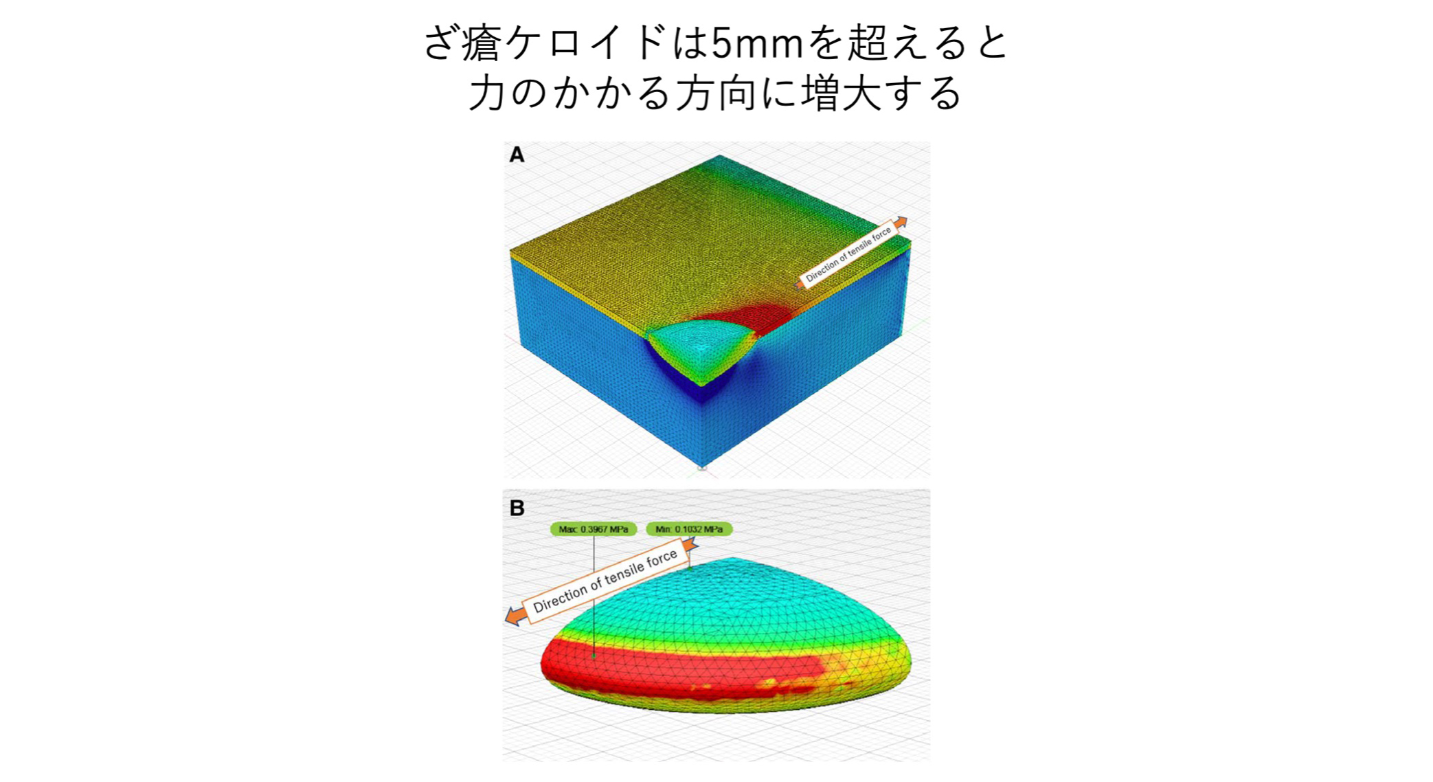21. ざ瘡ケロイドは5mmを超えると張力によって円型から紡錐形に変化する