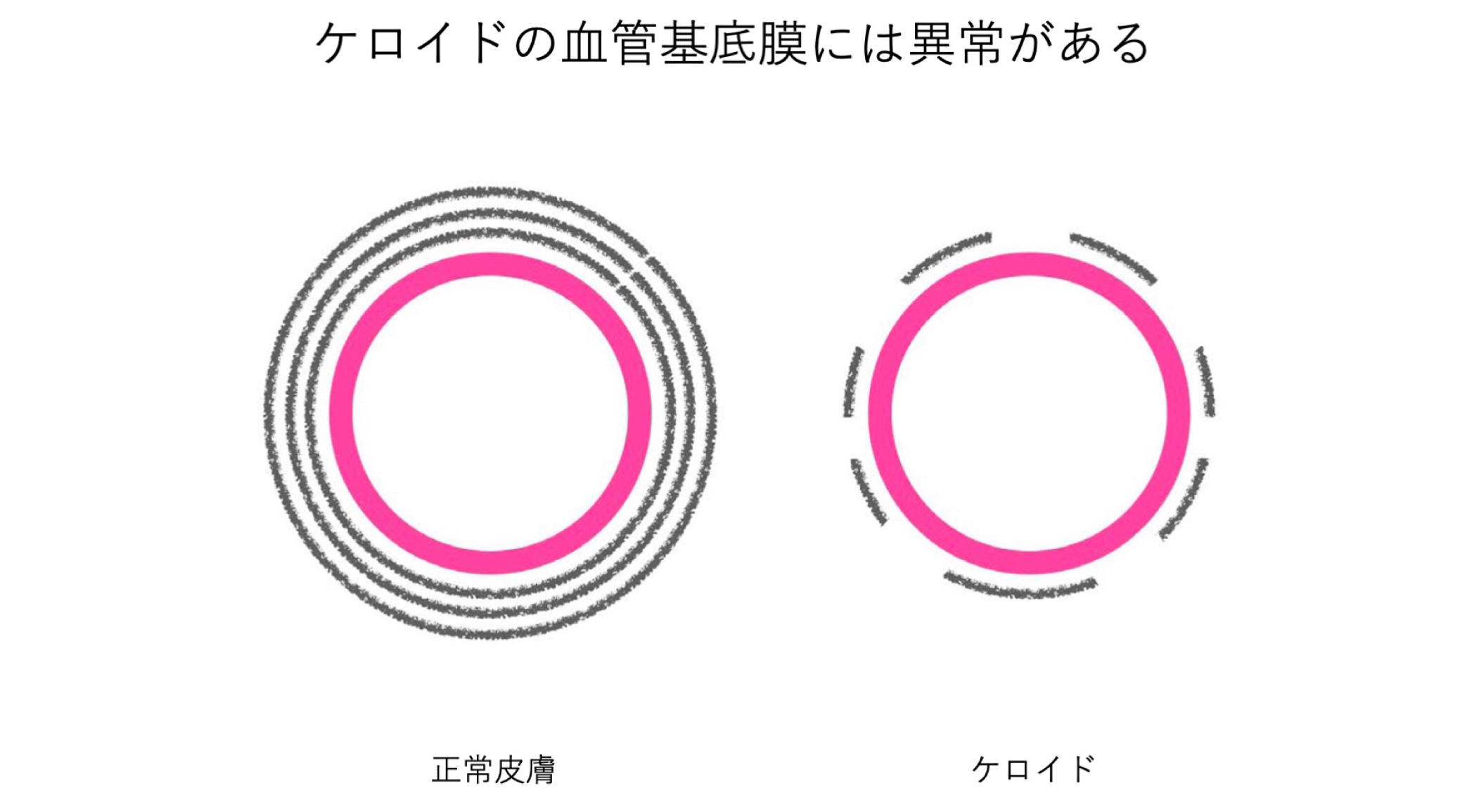 22. ケロイドでは血管基底膜に異常がある？