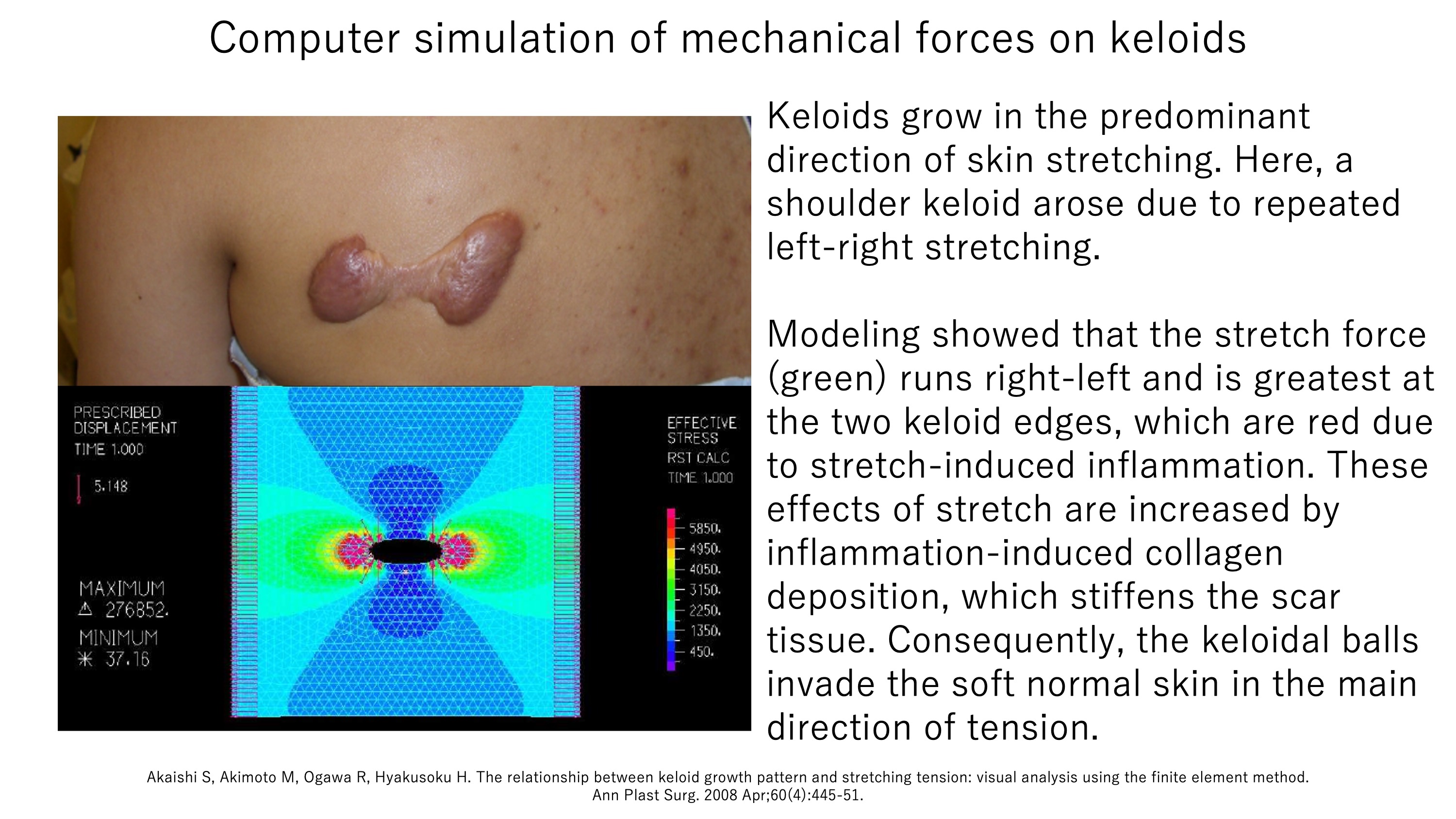 Keloid Research Survey - to understand keloid patient issues