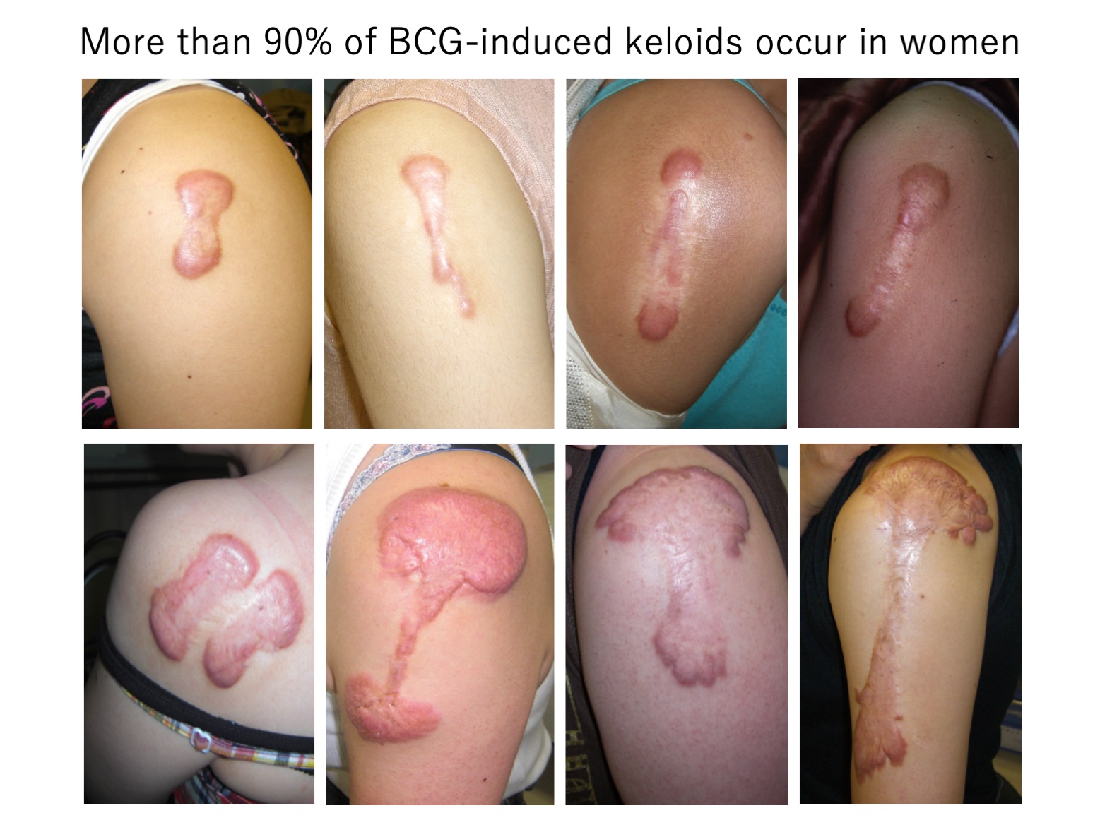 keloid laboratory