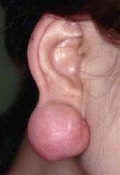 耳のケロイド
