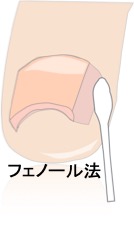 フェノール法