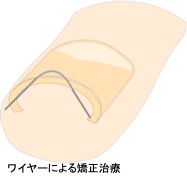 巻き爪